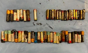 Acesta este cel mai mare număr de baterii ingerate raportat vreodată jpg