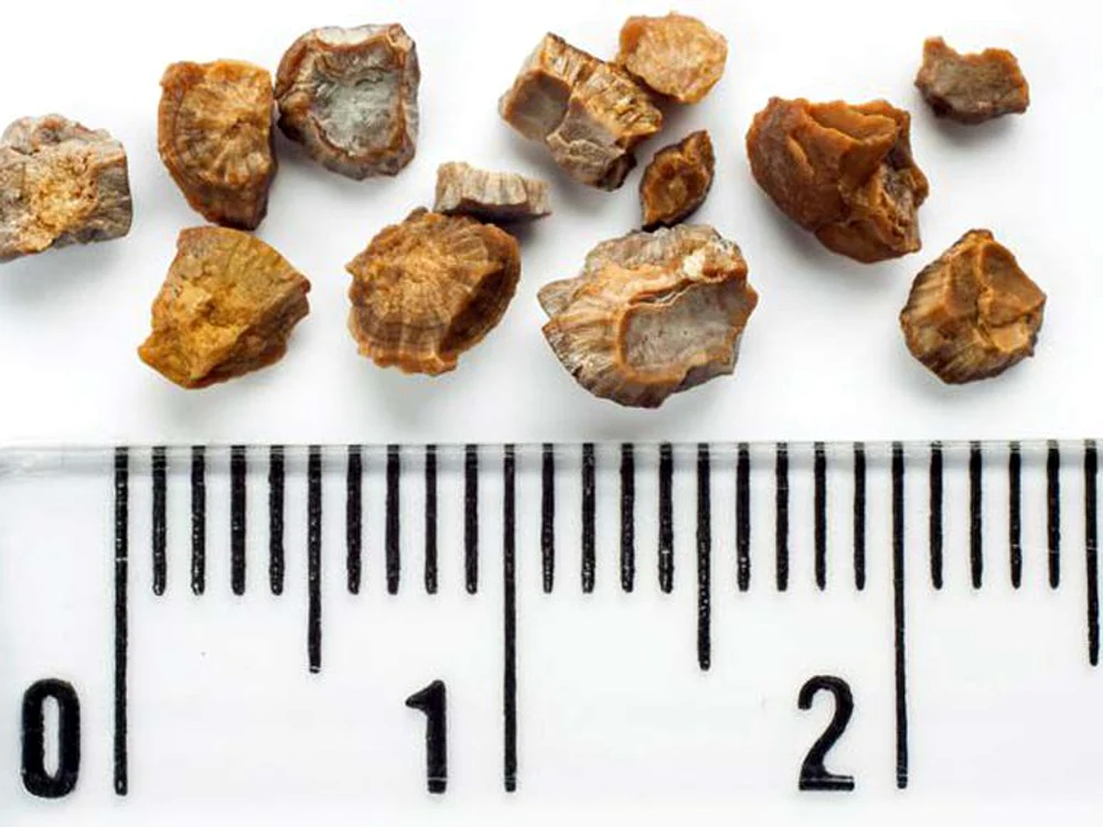 
    5 ceaiuri contra pietrelor la fiere  