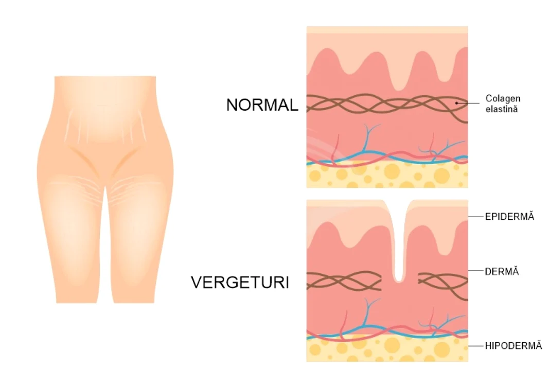 Vergeturi