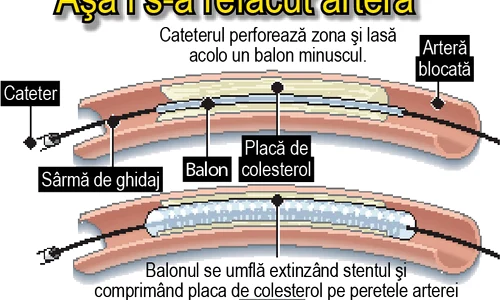 Aşa i s a refăcut artera jpeg