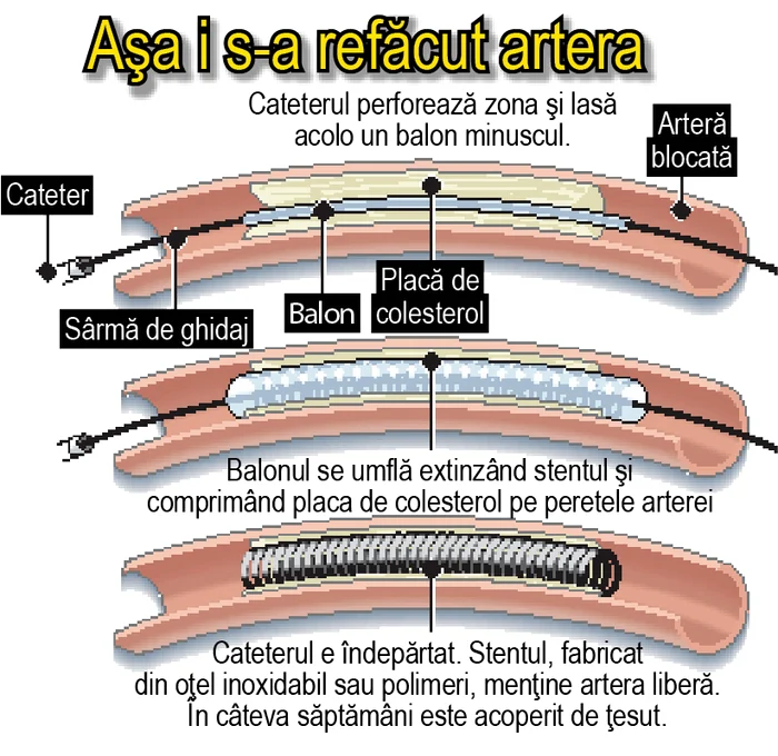 Aşa i s-a refăcut artera