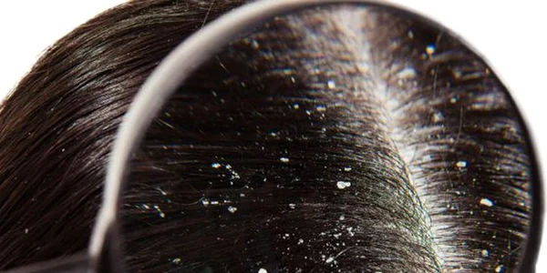 5 remedii naturale care te scapă de mătreaţă