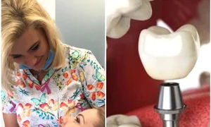 Coroana este fixată pe un șurub, care se înfiletează în implant jpeg