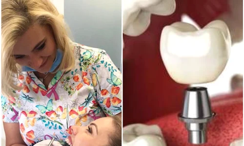 Coroana este fixată pe un șurub, care se înfiletează în implant jpeg
