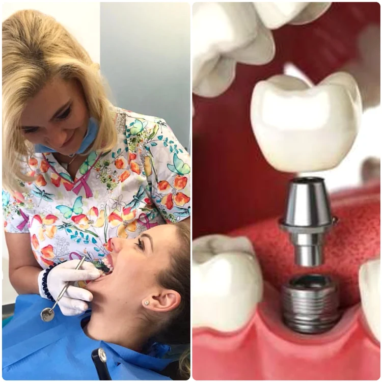 Coroana este fixată pe un șurub, care se înfiletează în implant