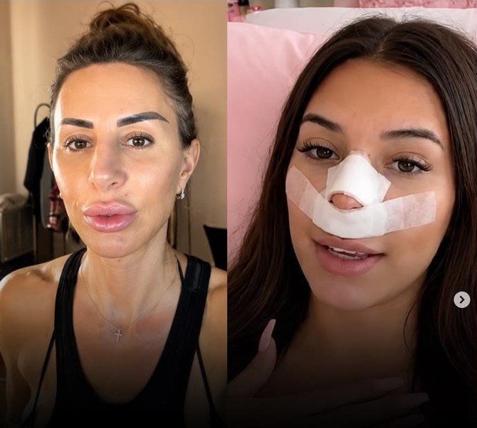 Influencerița care și-a făcut rinoplastie pentru ca viitorii săi copii „să nu îi moștenească nasul”. Ideea a primit replici pe măsură: „La o operație pe creier te-ai gândit?”