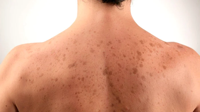 Medicul dermatolog ne dezvăluie când ar trebui să fim îngrijorați de petele solare