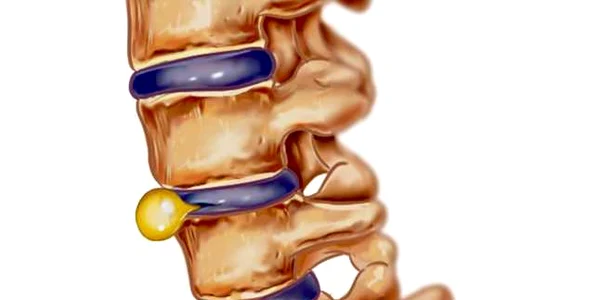 hernia de disc