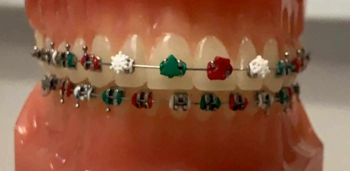 A luat naştere un nou trend: aparatele dentare accesorizate de sărbătoare
