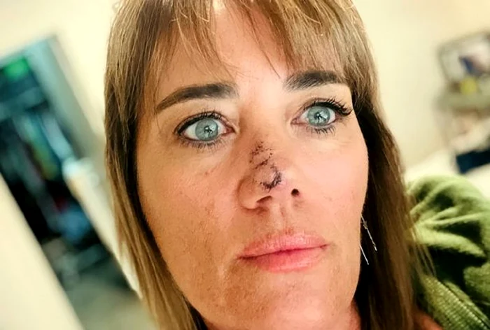 Așa arăta Michelle în urma intervenției / foto: Social media