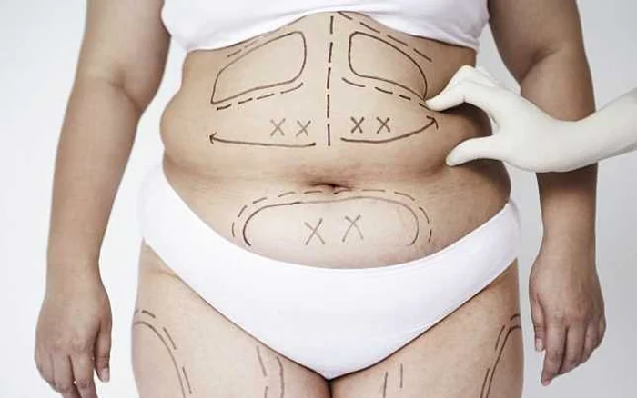 lipoaspiratie