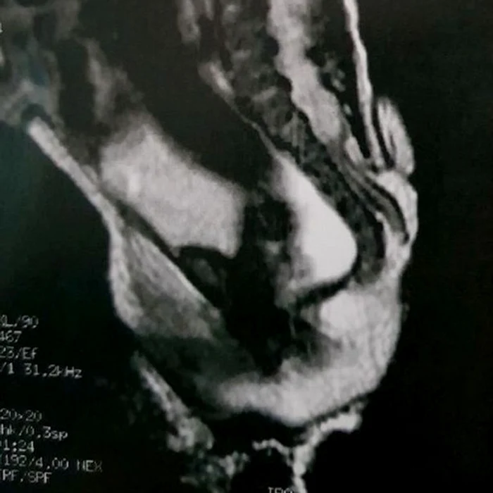 FOTO Journal of Pediatric Surgery Case Reports