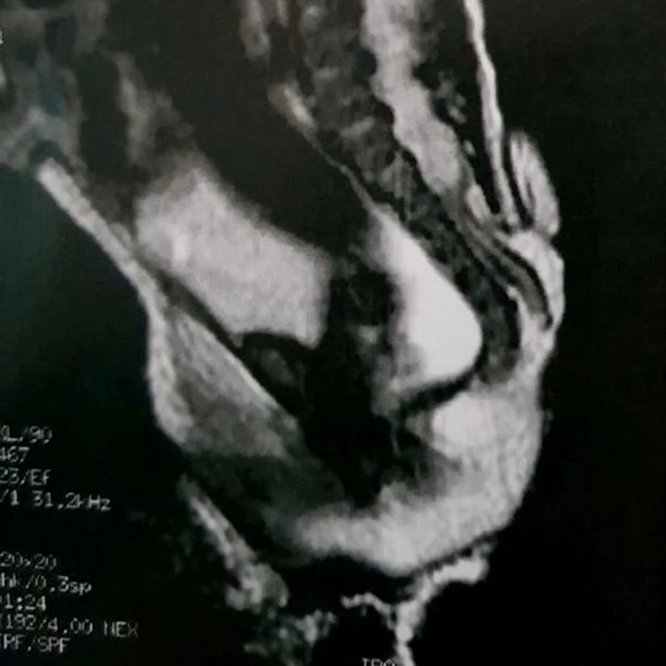 FOTO Journal of Pediatric Surgery Case Reports