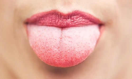 candidoza bucală jpeg