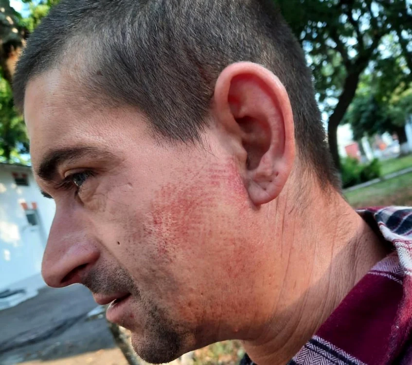 Bărbatul are urma unei tălpi de bocant pe faţa sa  Foto: sabotorii.ro