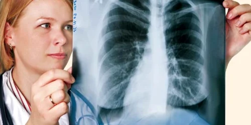Dacă sunteţi în categoriile de risc, faceţi anual o radiografie pulmonară, analize de spută sau tomografie computerizată  