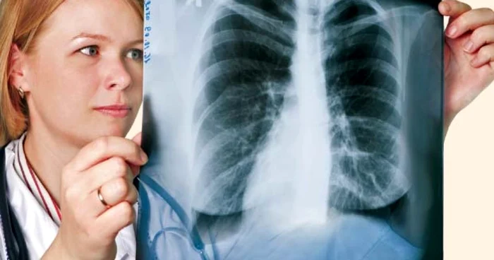 Dacă sunteţi în categoriile de risc, faceţi anual o radiografie pulmonară, analize de spută sau tomografie computerizată