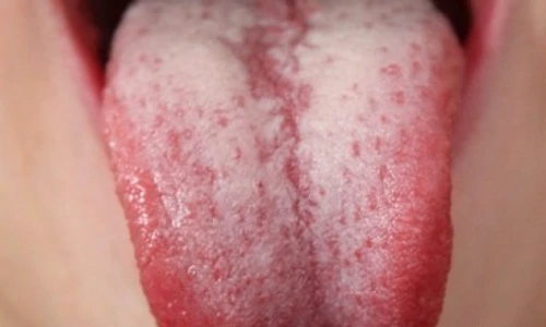 1 ai limba incarcata de depozite albicioase sau galbui mergi imediat la doctor nu este de joaca 9mdu jpg jpeg