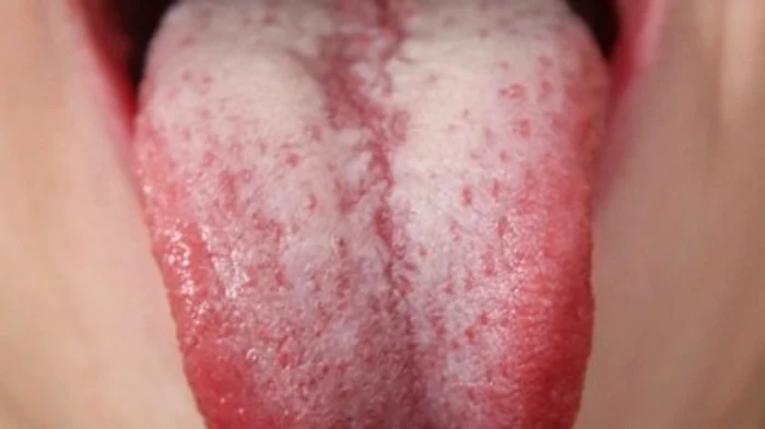 1 ai limba incarcata de depozite albicioase sau galbui mergi imediat la doctor nu este de joaca 9mdu jpg jpeg