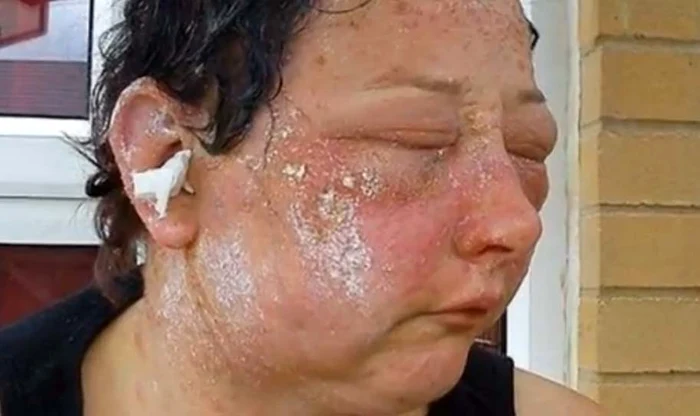 Faţa i-a fost arsă