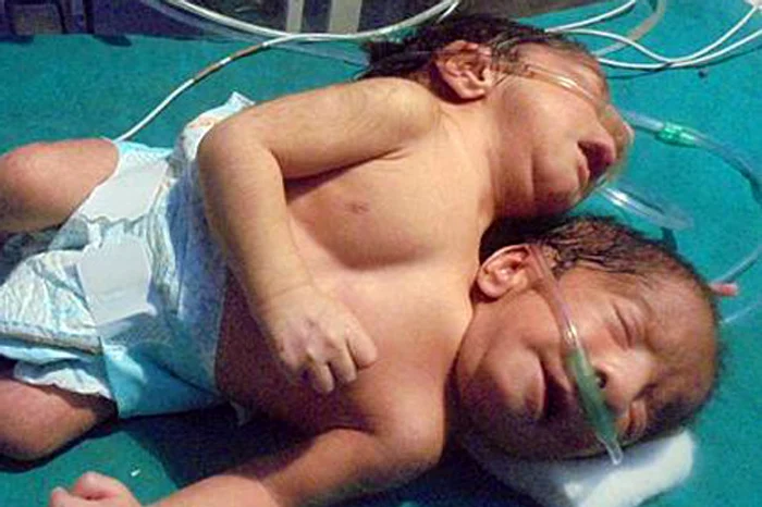 Părinţii vor cu orice preţ să-şi separe copiii siamezi