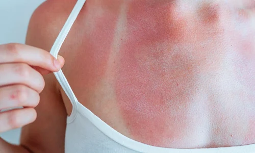 arsuri piele soare jpg