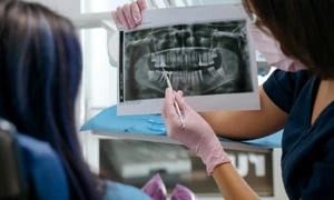 Implant dentar intrebari pe care merita sa le adresezi medicului inainte de interventie jpg