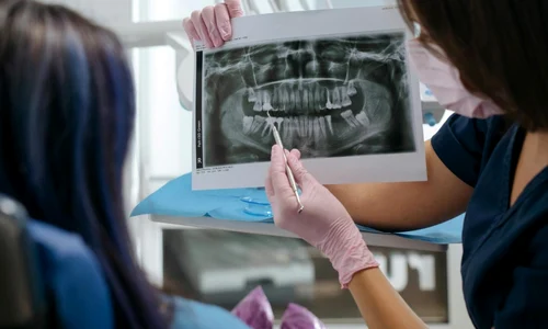 Implant dentar intrebari pe care merita sa le adresezi medicului inainte de interventie jpg