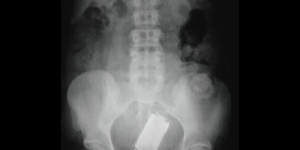 Un iPod a fost descoperit în interiorul unui bărbat