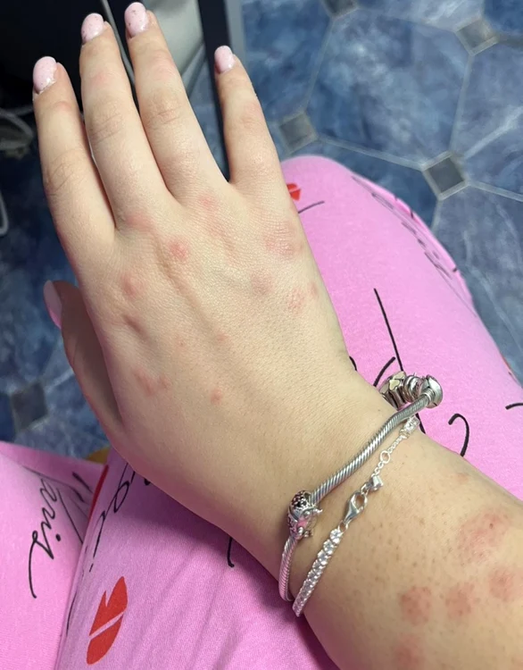 Fata care a ajuns la spital cu înțepături de ploșnițe Foto: Facebook Octavian Berceanu