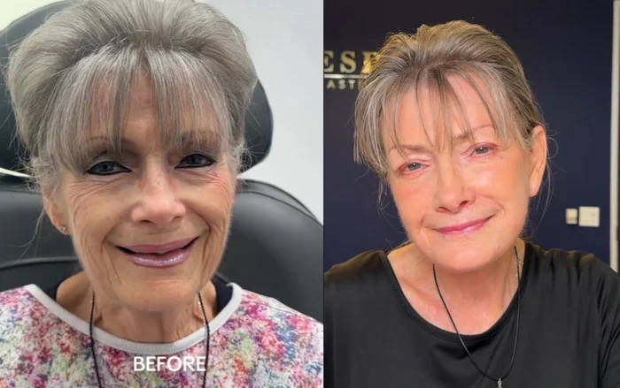 Așa arată o femeie de 70 de ani după un facelift spectaculos / foto: colaj captură video TikTok