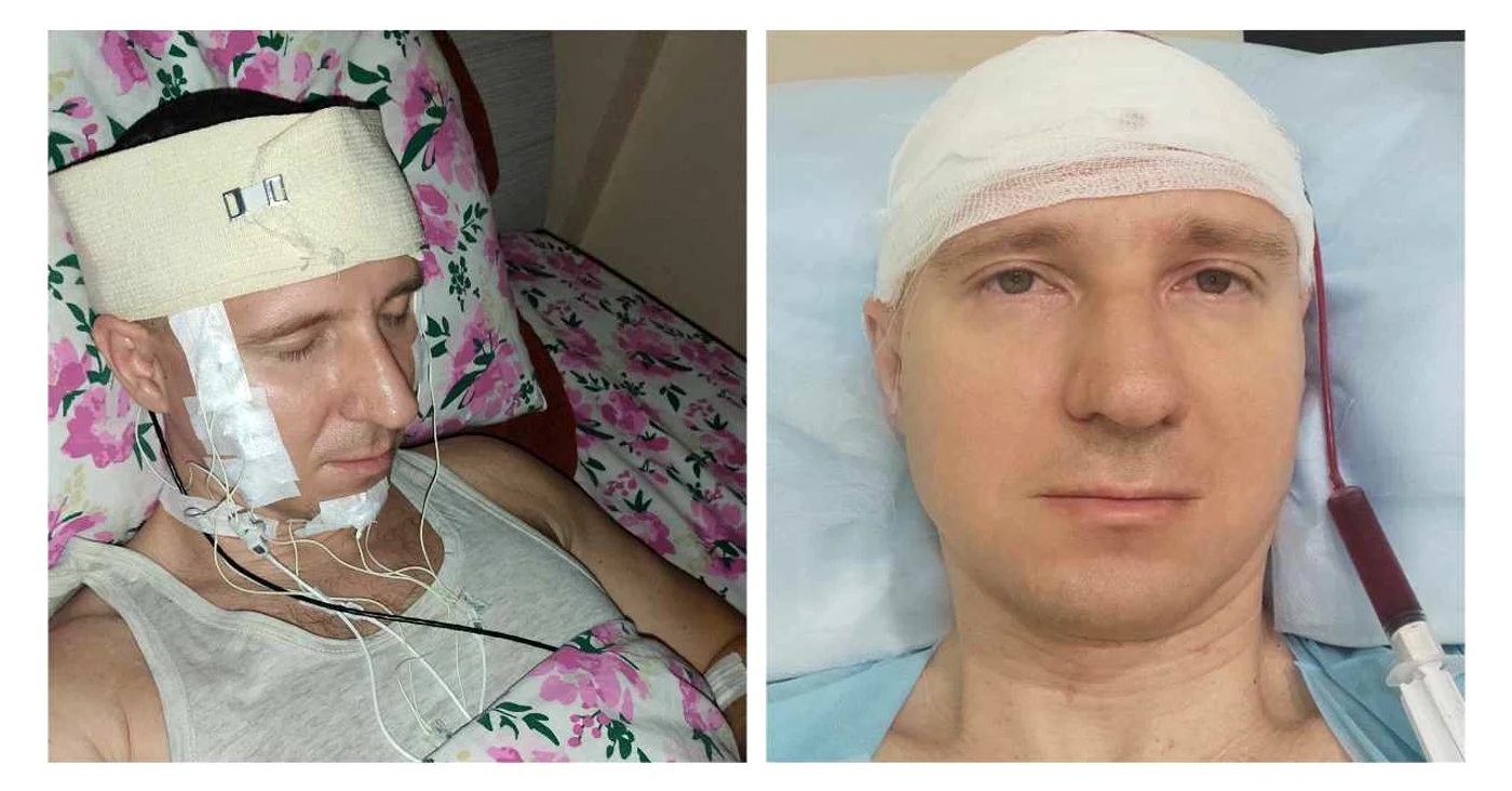 Michael Raduga, fotografiat după operația pe creier pe care și-a făcut-o singur