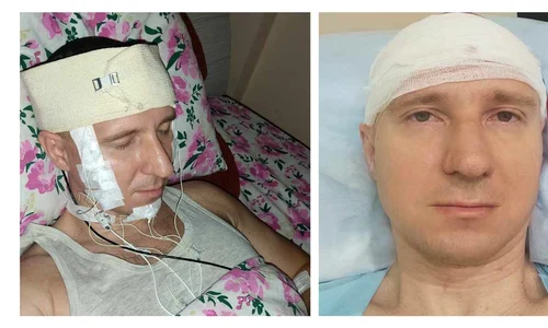 michael raduga operatie pe creier jpg