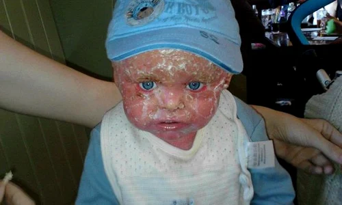 pay jayden watson rare skin disease jpeg