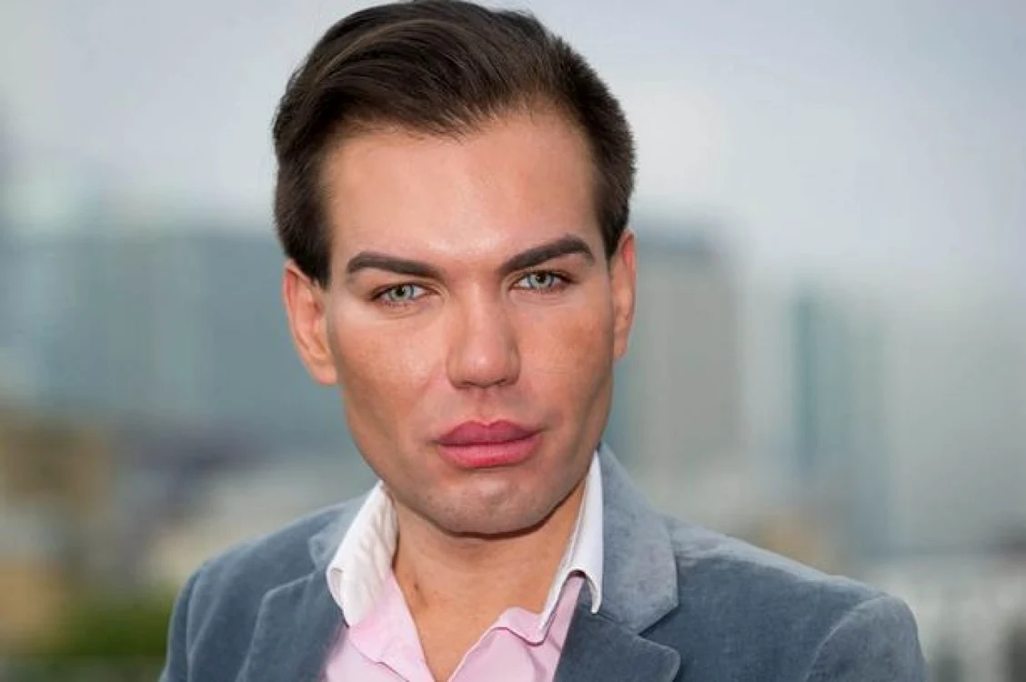 Rodrigo a apelat îne nenumărate ori la chirurgia estetică pentru a-şi îmbuătăţi aspectul fizic, fiind complexat de înfăţişaera lui de dinainte de operaţii. FOTO Daily Mirror