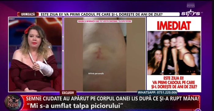 Semnul apărut pe genunchiul Oanei Lis - Foto: captură TV