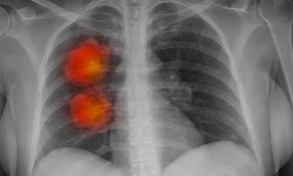 Metoda revoluționară bazată pe inteligența artificială care poate depista cancerul