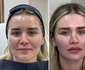 Alesia Mitriță, înainte și după intervenția estetică  Sursa/Zeedestethics