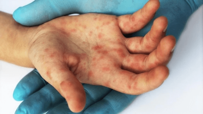 Ce e gripa tomatelor, noua maladie foarte contagioasă care afectează copiii și se răspândește în India