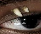 Dinte crescut ideasupra ochiului  Foto AAOJOURNAL (1) webp