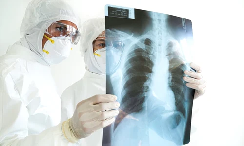 radiografie pulmonara shutter jpeg