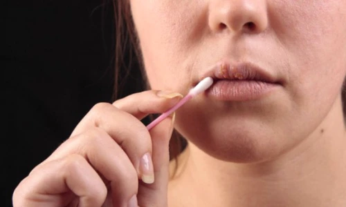 Cum scapi de herpes  Remediu rapid jpeg