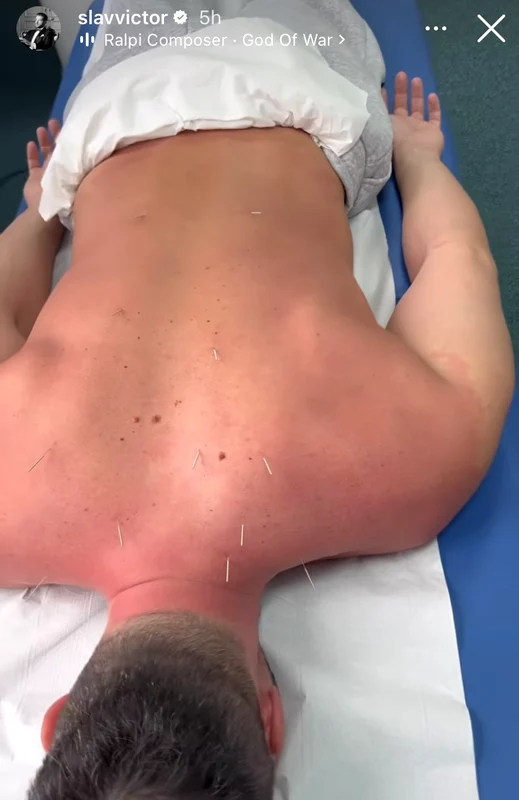Slav, la acupunctură sursa Instagram