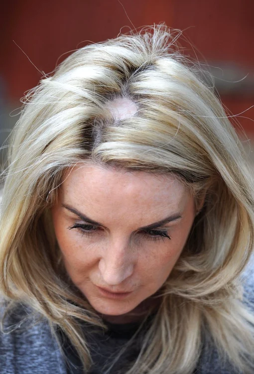Din cauza vizitelor la solar, Justine a făcut cancer de piele în două zone diferite de pe corpFoto: mirror.co.uk