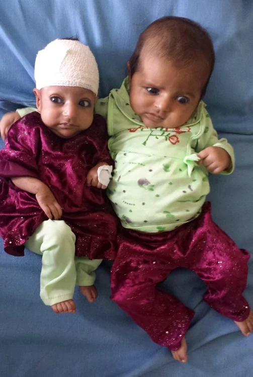 Fetiţa cu două capete (foto:afp)