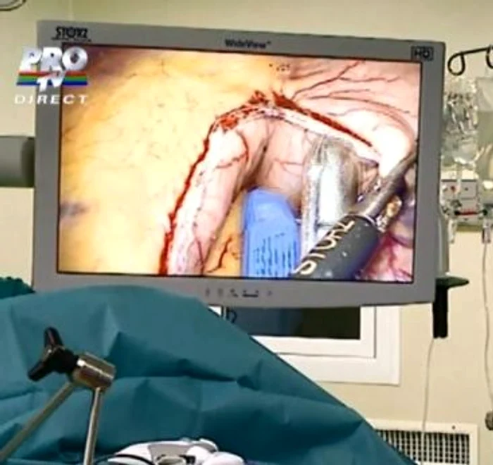 Stomacul ceie lai grase femei