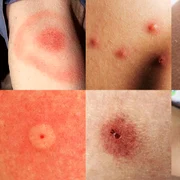 Cum arată mușcăturile și înțepăturile de insecte Foto Sur in English dms