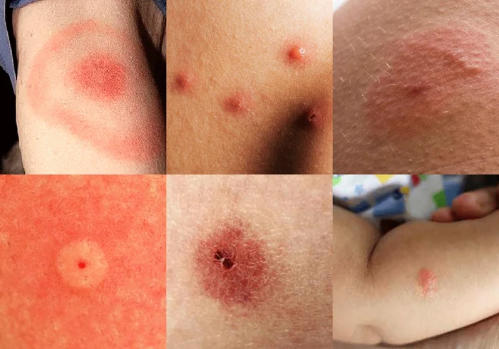Cum arată mușcăturile și înțepăturile de insecte Foto Sur in English dms