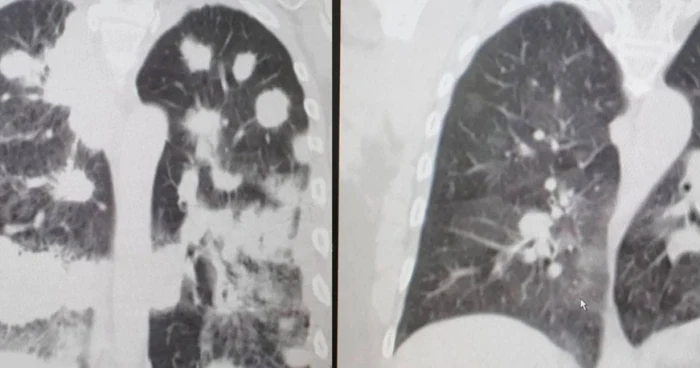 Leziunile pulmonare în cazul unui pacient care are şi alte boli (stânga), respectiv în cazul unui pacient fără comorbidităţi, în infecţia cu SARS-CoV2