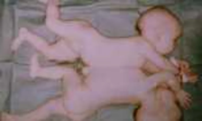Siamezele au fost născute la maternitatea din Pitesti